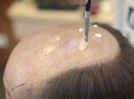 Preparation Before Attaching A Hair Replacement System At Home Or Salon