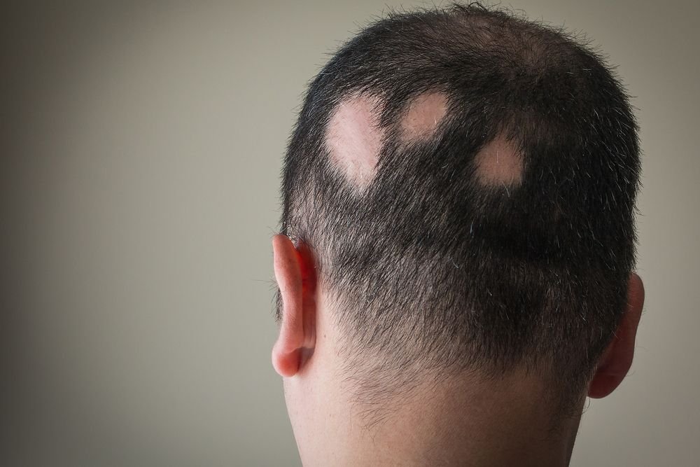 Alopecia Areata
