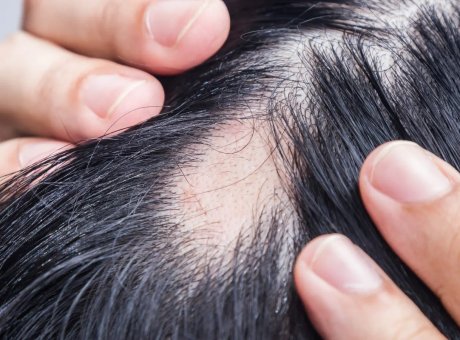 What’re Effective Solutions for Covering Man’s Alopecia Areata Professionally?