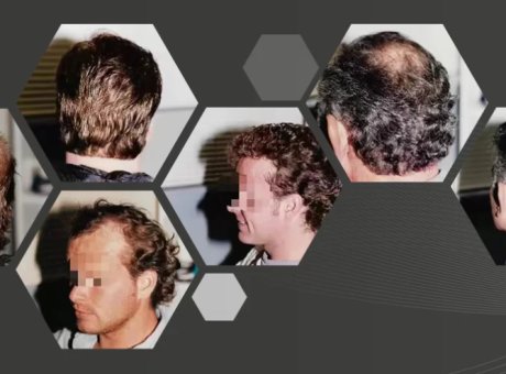 Mature vs. Receding Hairline: Choose the Right Wig